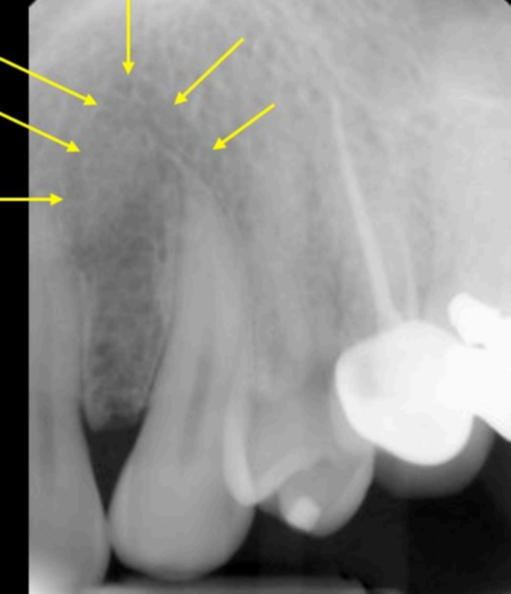 <p>What is causing the well-defined round, radiolucent area indicated?</p>