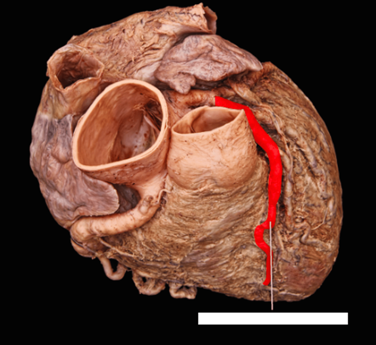 <p>in the anterior interventricular sulcus</p>