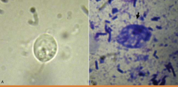 <p>no, it have a pseudocysts form </p>