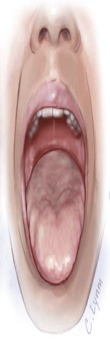 <p><span style="color: rgb(0, 0, 0)">Mallampati 4 score</span></p>