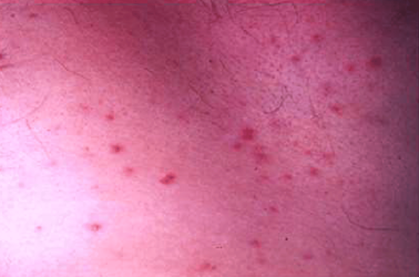 <p>-rare</p><p>-pts tend to have widespread systemic illness</p><p>-hematogenous spread leads to microabscesses throughout parenchyma</p>