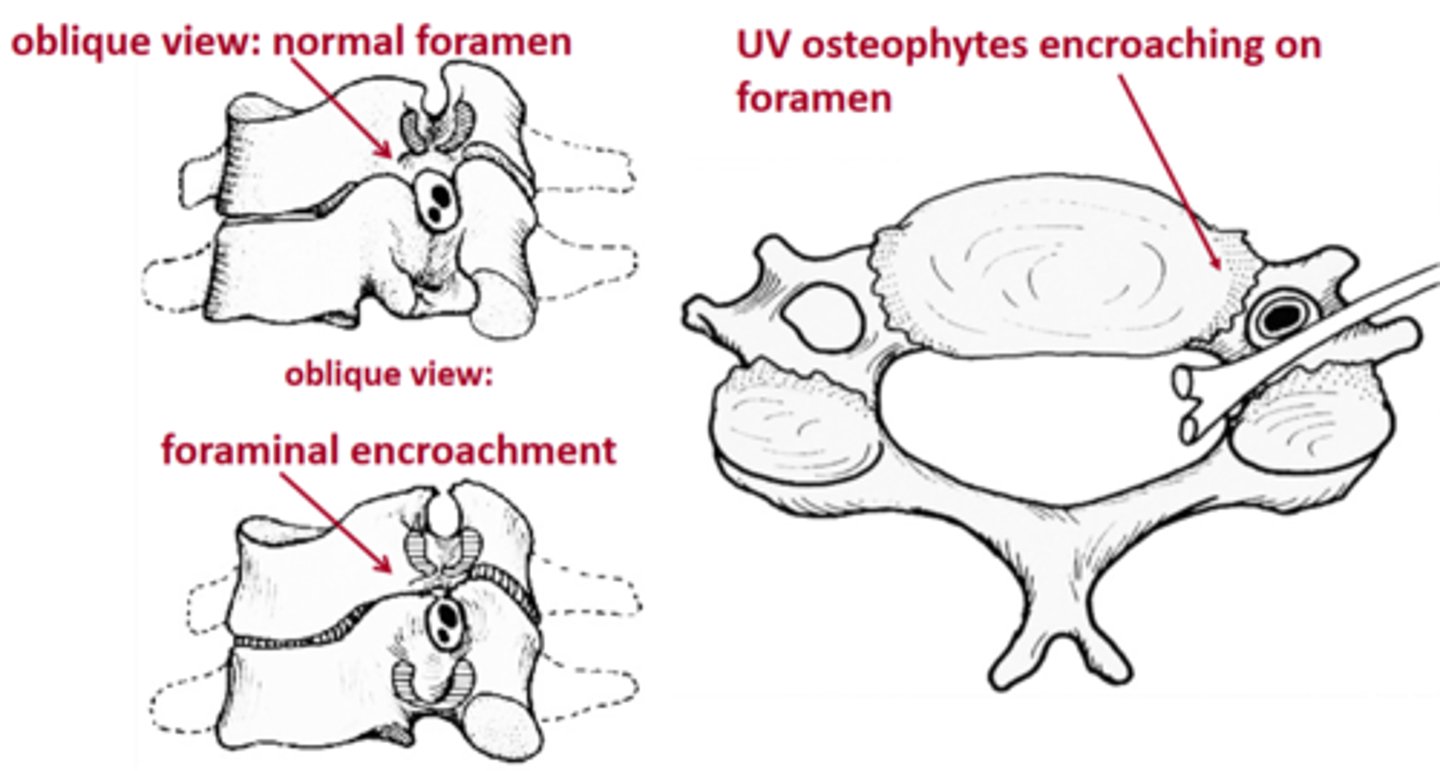 <p>nerve root,</p><p>spinal cord,</p><p>vertebral artery</p>