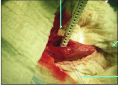 <p>What type of suture should you use for stay sutures?</p>