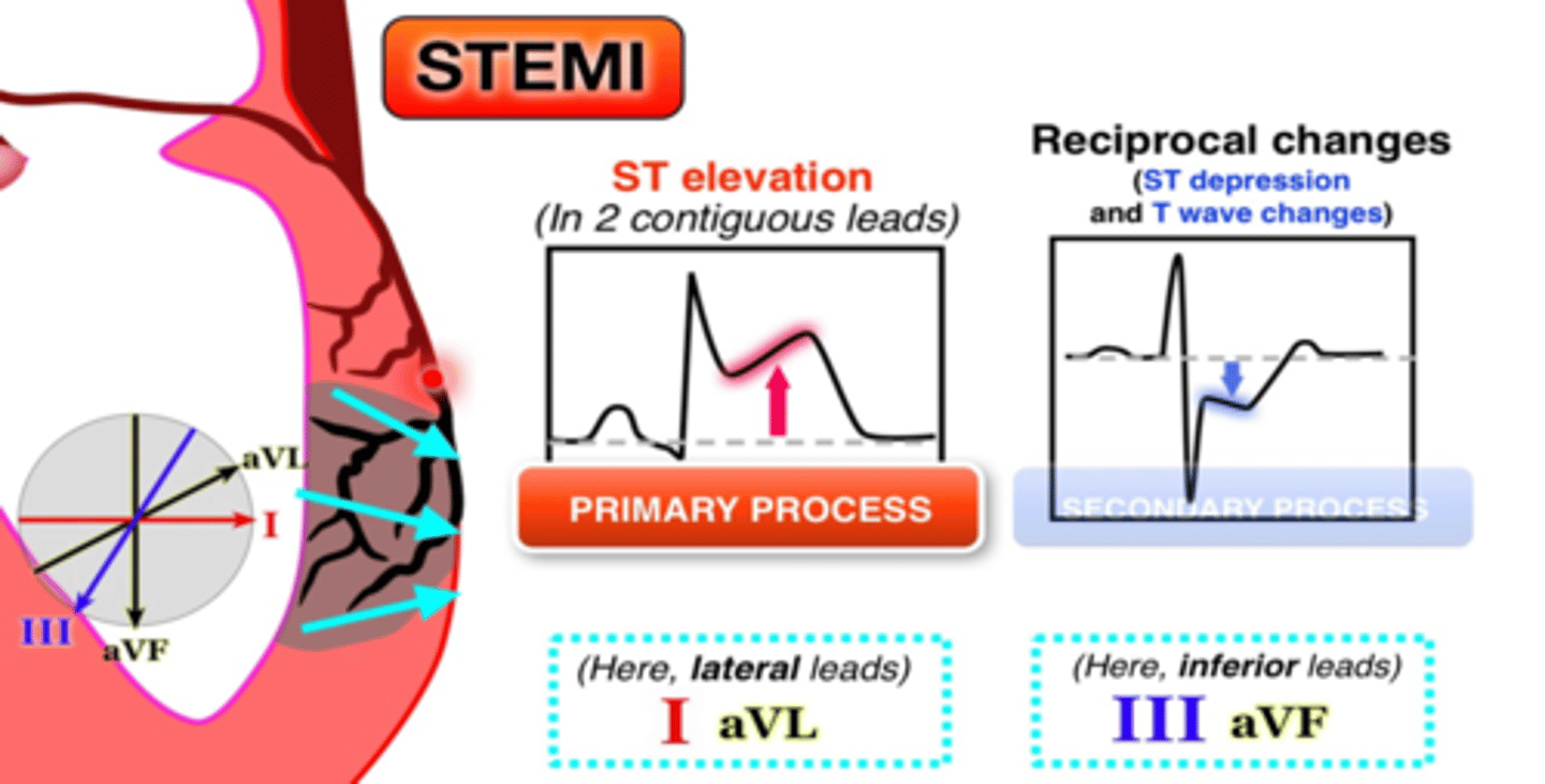 <p>- ST elevation can be seen in numerous other conditions</p><p>- reciprocity confirms the diagnosis of STEMI</p><p>- mirror image of injury: presence of ST depression in leads opposite of ST elevation (i.e., lateral leads vs. inferior leads)</p>