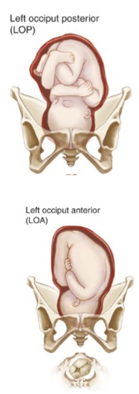 <p>maternal risks</p><ul><li><p>intense pain on small of back “back labor”</p></li><li><p>prolonged labor</p></li><li><p>increased risk of assisted vag delivery, perineal laceration, C/S </p></li></ul><p>clinical therapy</p><ul><li><p>hands/knees position to allow fetal rotation</p></li><li><p>vaginal or C/S</p></li></ul>
