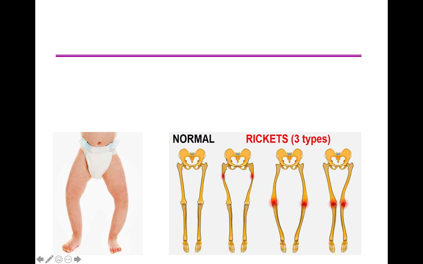 What disease is shown here?  How would you get it?