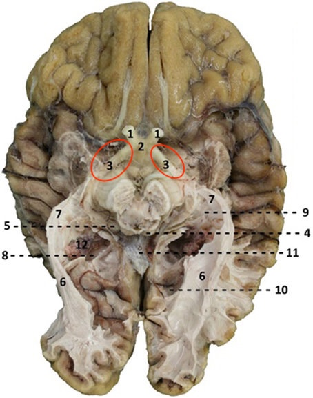 <p>Bundle of nerve fibers that carries visual in formation from the optic chiasm to the left and right geniculate bodies as a part of the visual pathway</p>