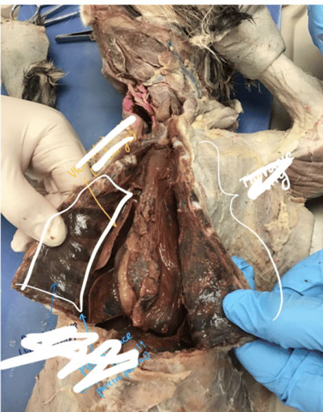<p>outer layer of pleura lying closer to the ribs and chest wall</p>
