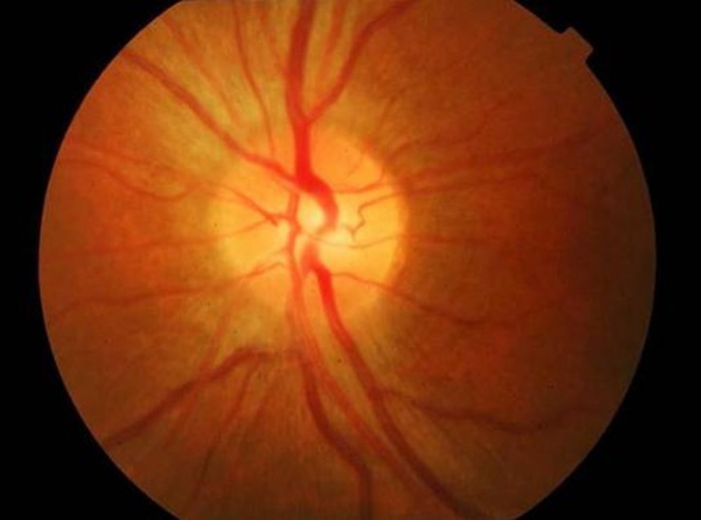 <p>Acute unilateral loss of vision, central scotoma, pain with eye movement (EOM), loss of color vision, photopsia, and a relative afferent pupillary defect (Marcus Gunn pupil).</p>
