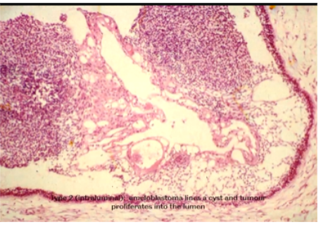 <p>Ameloblastoma lines a cyst and tumour proliferates into the Lumen</p><p>single cyst growing into lumen</p>