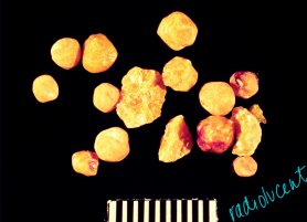 <p><span style="background-color: transparent;"><strong>Cystine Uroliths</strong></span></p>