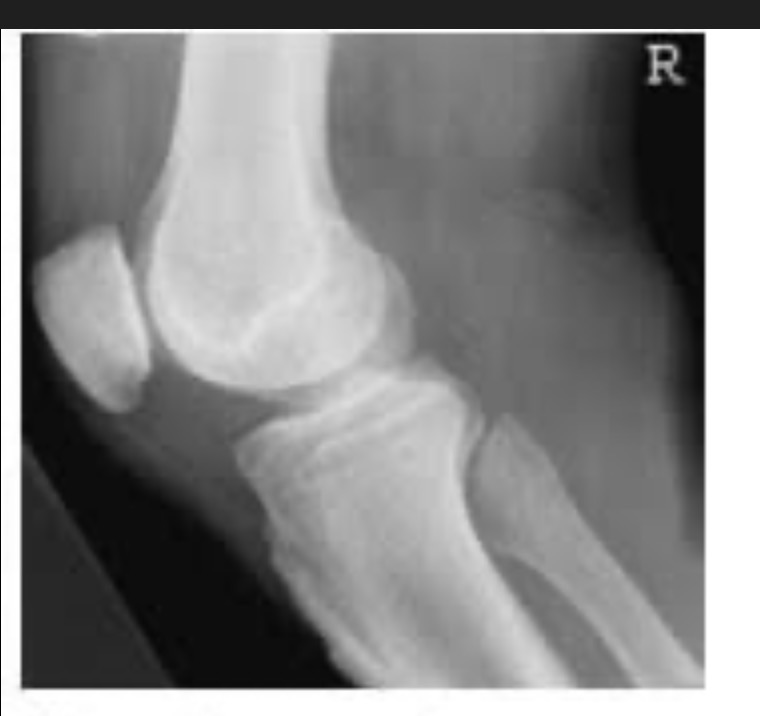 <p>Is the patient in true lateral with proper tube angle? Explain.</p>