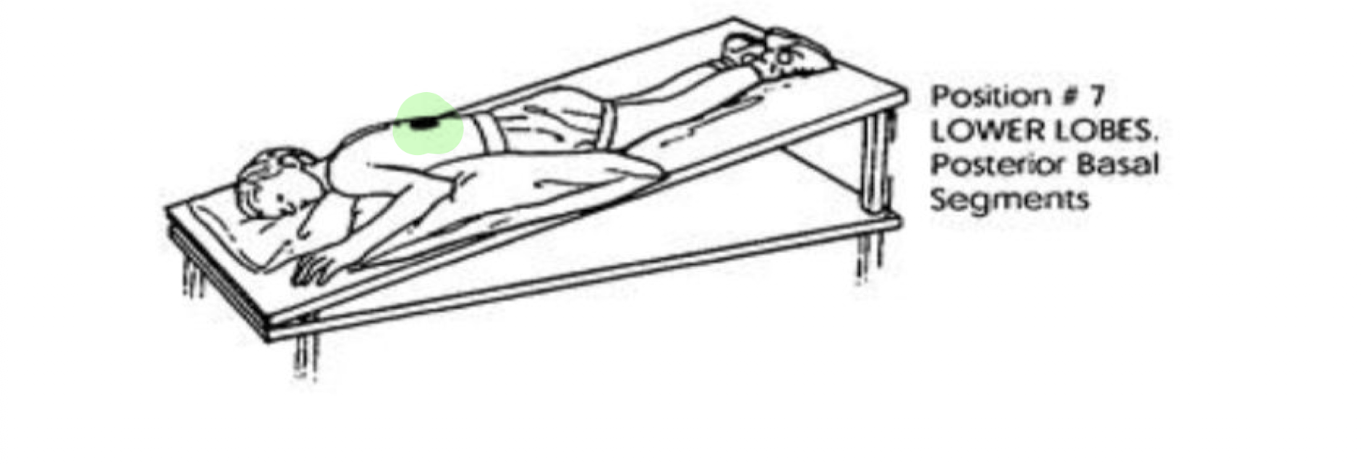 <ul><li><p>Prone c Head Down 30 deg</p></li></ul><p></p>