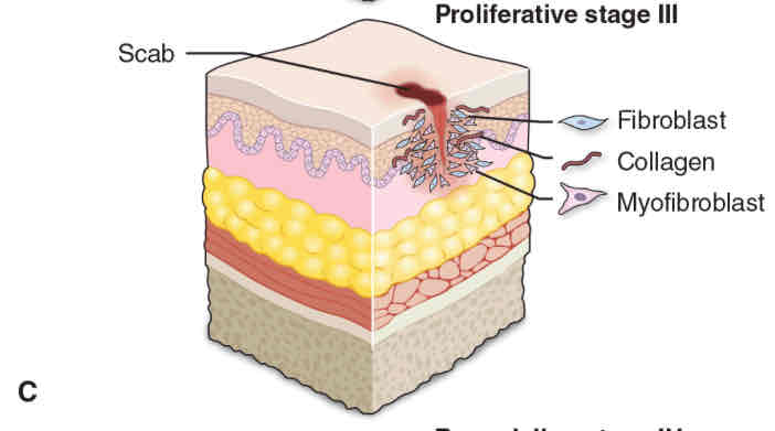 <p><strong>Fibroblasts </strong>(a CT tissue)</p><ul><li><p>Synthesizes <strong>collagen</strong></p></li><li><p>24 - 48 hrs, forms <strong>granulation</strong> tissue for foundation of scar tissue</p></li><li><p>Wound contraction (due to shortening of fibroblasts)</p></li></ul><p><strong>Creation of new BV (Angiogenesis)</strong></p><ul><li><p>Granulation tissue Secretes VEGF (vascular endothelial growth factor)</p></li></ul><p><strong>Epithelial cells (Epithelialization)</strong></p><ul><li><p>Migrate and proliferate to fill wound gap</p></li></ul><p></p>