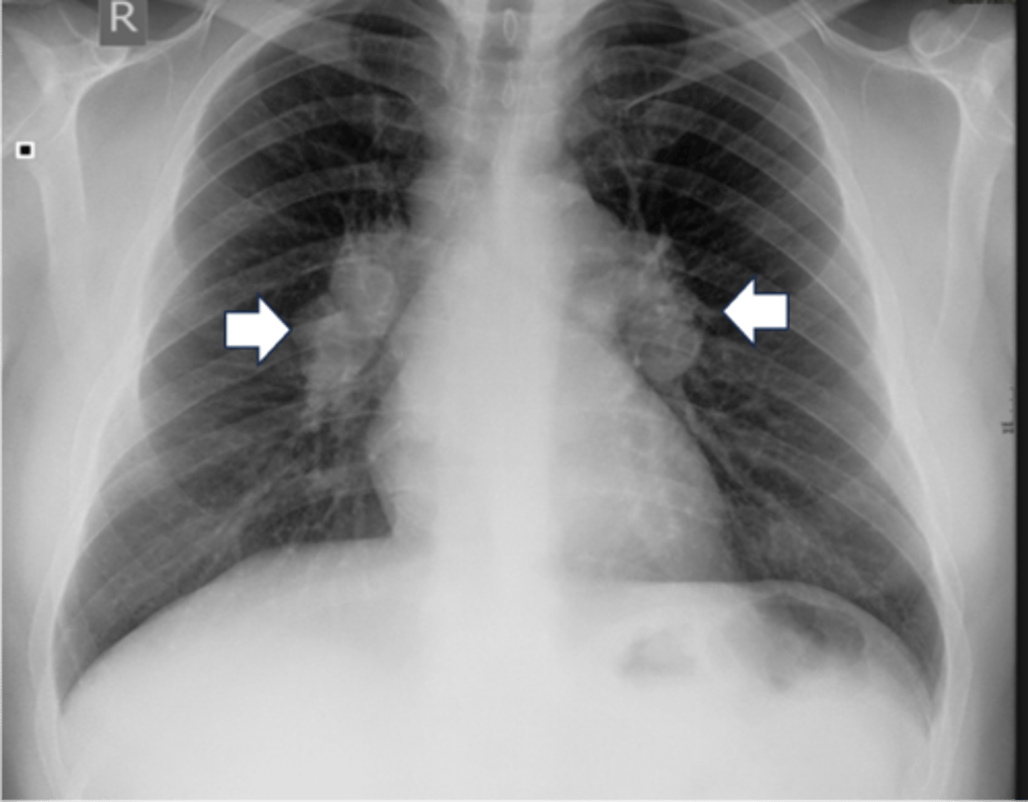 <p>-TB or sarcoidosis</p>