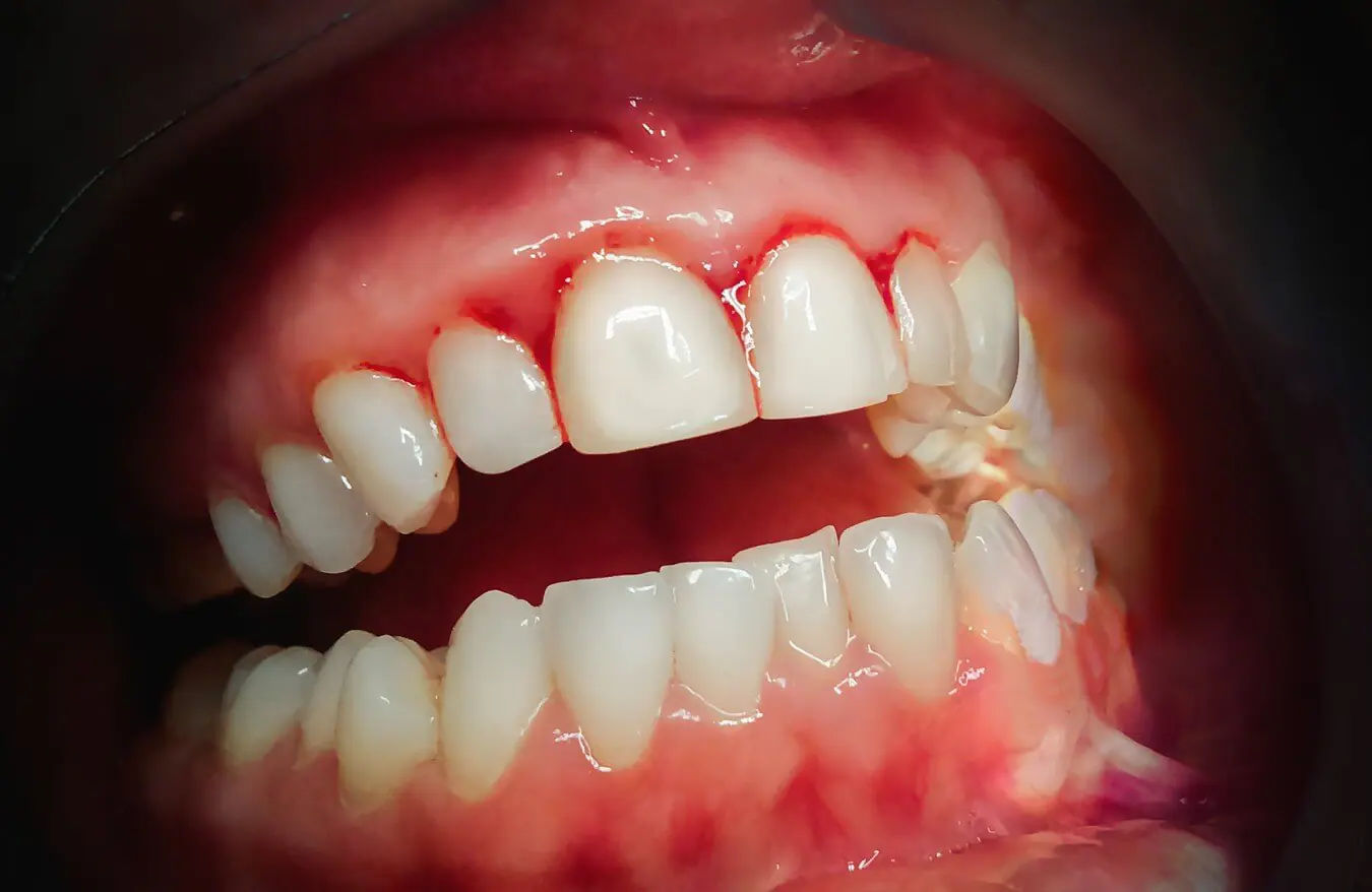 <p>PP: sudden gingivitis</p><p>E: teens<br>young adults<br>uncommon</p><p>CM: ulcers in interdental papillae→spread to gum margin→gray pseudomembrane develops<br>halitosis<br>red+painful gums<br>bleeds easily</p>