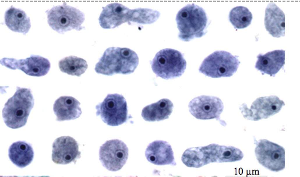 <p>Name: Endolimax nana</p><p class="p1">Stage: trophozoite</p><p class="p1">*Large blot-like endosome<span>, irregular shape</span></p>