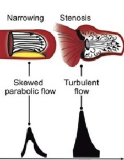 <p><strong>Spectral broadening</strong> - <u>thicker</u> frequency window that can fill the window depending on grade of narrowing or stenosis</p>