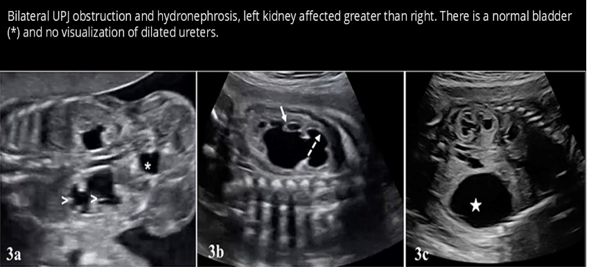<p>which condition is the most common cause of hydronephrosis in a fetus</p><p>a) ureteropelvic junction obstruction</p><p>b) posterior urethral valves</p><p>c) bladder extrophy</p><p>d) aqueductal stenosis </p>