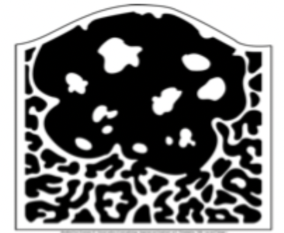 <p>A type of lesion appearance where it exhibits both a radiopaque and a radiolucent component. Often represent calcifying tumours. </p>