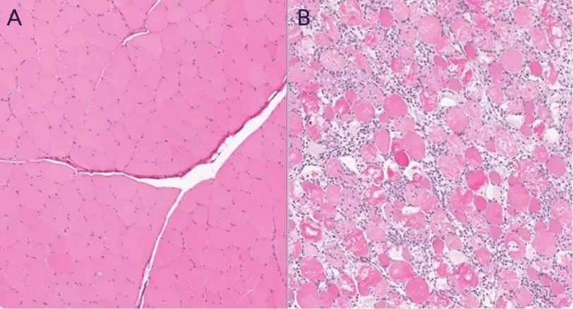 <p><span style="background-color: transparent;">Attached are two different muscle fiber segments. </span></p><p><span style="background-color: transparent;">If Picture A showcases normal skeletal muscle fibers, how would you describe the muscle segment in picture B?</span></p>