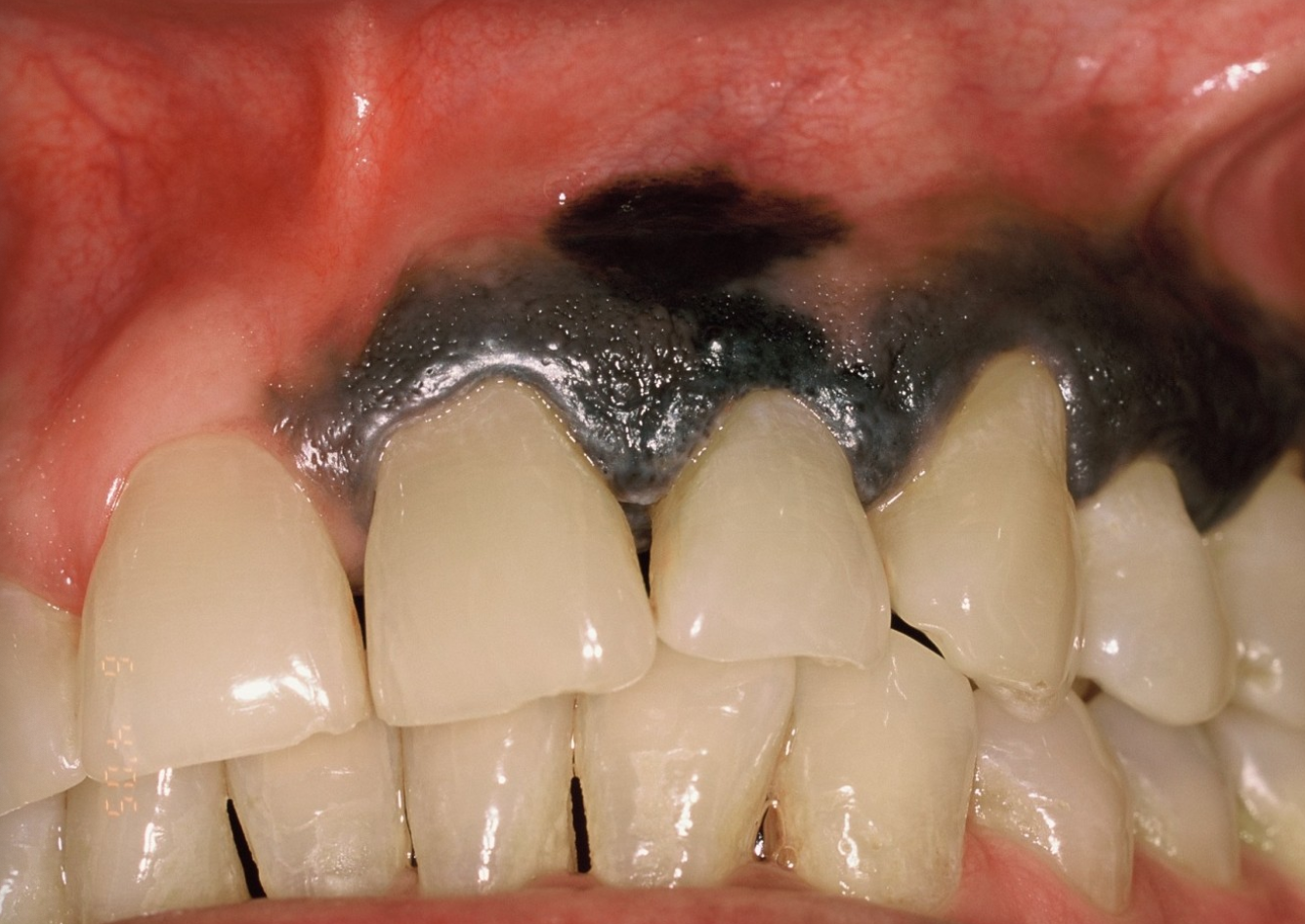 <p>10c. Which of the following descriptions meets the ABCED criteria for this lesion?</p><p><span><span>Symmetry and well defined</span></span></p><p><span><span>Irregular borders and variegated color </span></span></p><p><span><span>Uniform color and size</span></span></p><p><span><span>Evolution remained stable</span></span></p>