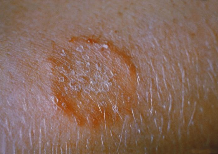 <p>PP: fungal infection of body</p><p>E: dermatophytes</p><p>CM: well-demarcated annular plaque<br>central clearing+peripheral <strong>scale</strong><br>contagious</p><p>DX: KOH prep</p><p>TX: topical econazole<br>topical ketoconazole</p><p>P: swollen lymph glands at sides/back of neck</p>