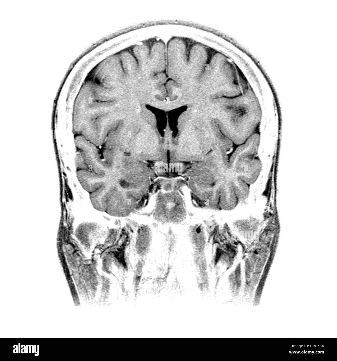 <p>Front/Back of the brain slice (like sandwich bread)</p>