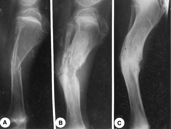 Thin cortex, wide medullary cavity, decreased bone density