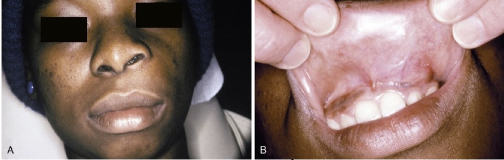 <ul><li><p class="p1"><strong>Swelling</strong> of upper lip, lateral to midline</p></li></ul><ul><li><p class="p1"><strong>Elevation</strong> of the ala of the nose</p></li><li><p class="p1"><strong>Obliteration</strong> of the maxillary mucolabial fold</p></li><li><p class="p1"><strong>Pain:</strong> uncommon, occurs if secondary infection develops</p></li><li><p class="p1"><strong>Rupture:</strong> may occur → drains into oral or nasal cavities</p></li></ul><p></p>