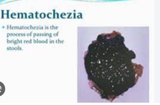 <p><span style="font-family: Droid Sans Mono, monospace">HEMATOCHEZIA</span></p>