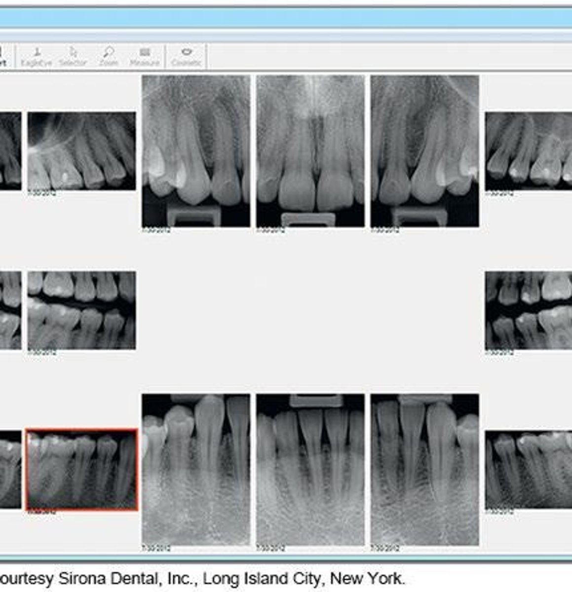 <p>Periapical and vertical bitewings; horizontal bitewings are not effective for moderate to severe bone loss.</p>