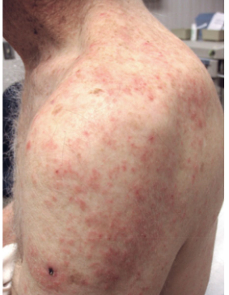 <p>papule</p><p>3 multiple choice options</p>