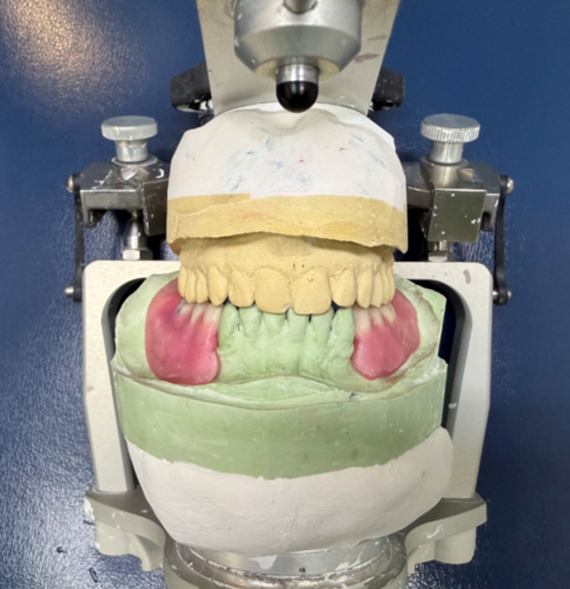 <p>Treatment plan is for a mandibular Resin Base RPD. Did the student use proper type of dental stone to form this working cast for the dental prostheses?</p>