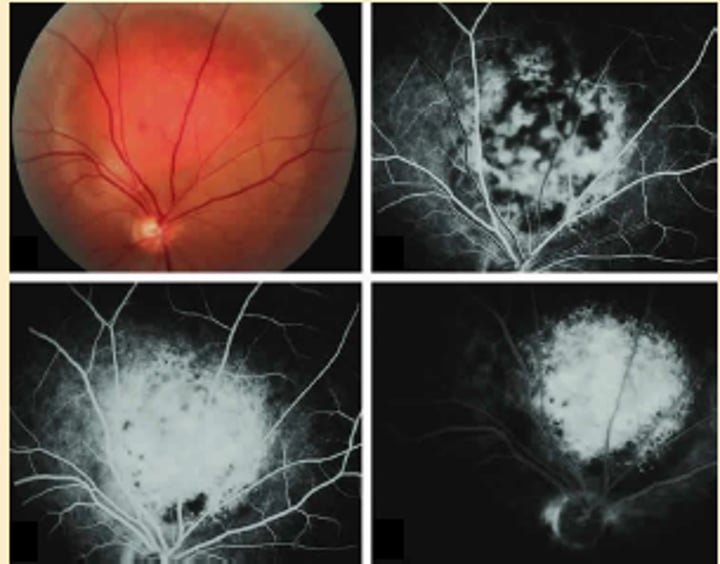 <p>Benign Vascular tumor - solitary or diffuse congenital form<br>-oval mass same color as choroid, solid lesion w sharp anterior surface and choroidal thickening<br>-Rapid spotty hyperfluorescence on FA<br>ICGA</p>