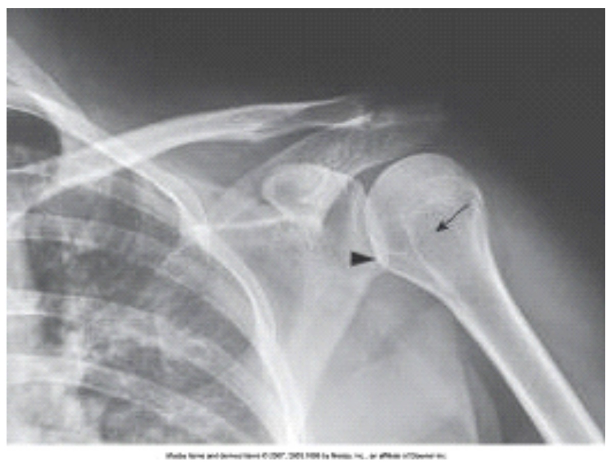 <p>The anatomy labeled in the image below by the arrowhead is the:</p>