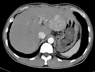 <p>Liver carcinoma</p>