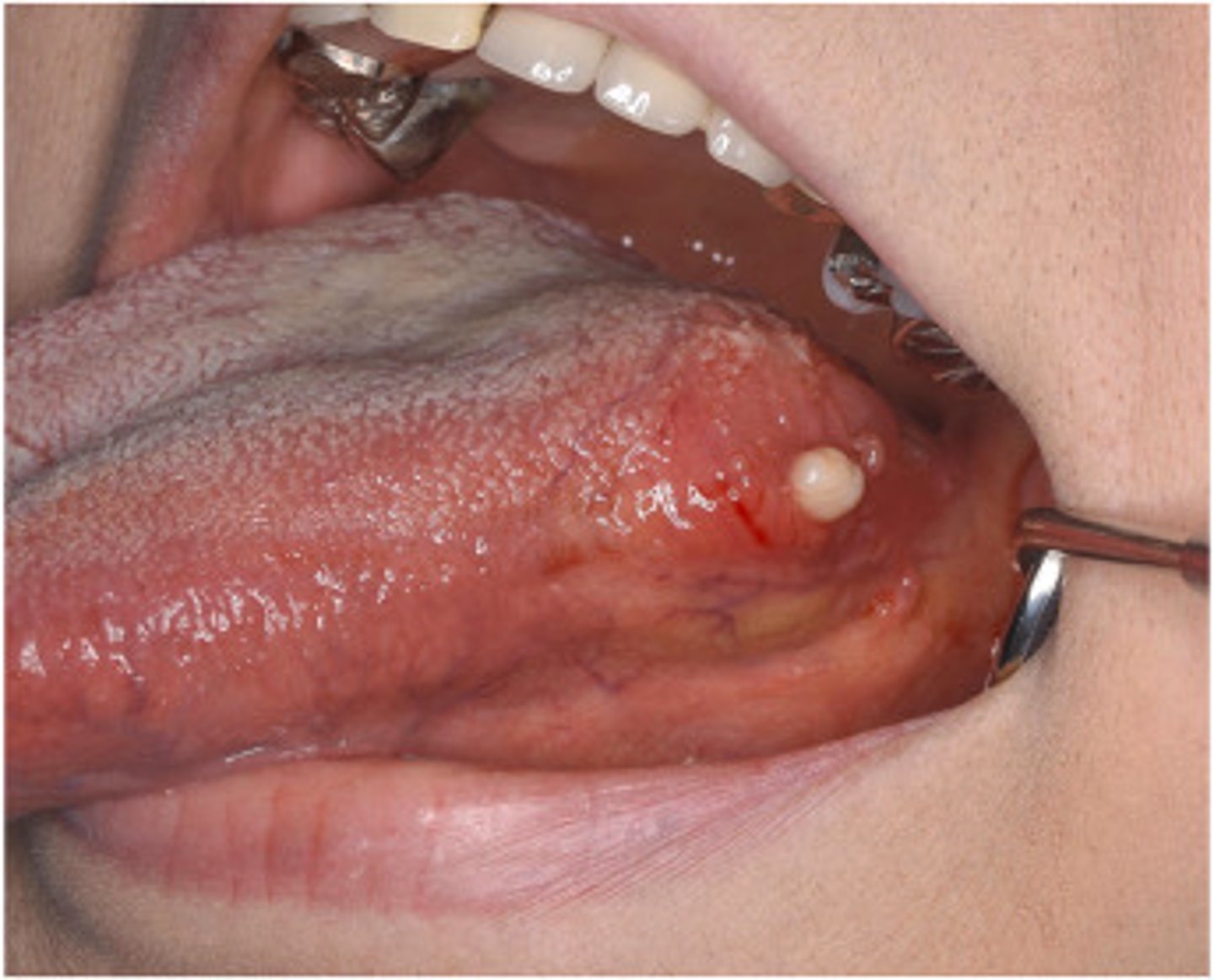<p>lymphoepithelial cyst</p>