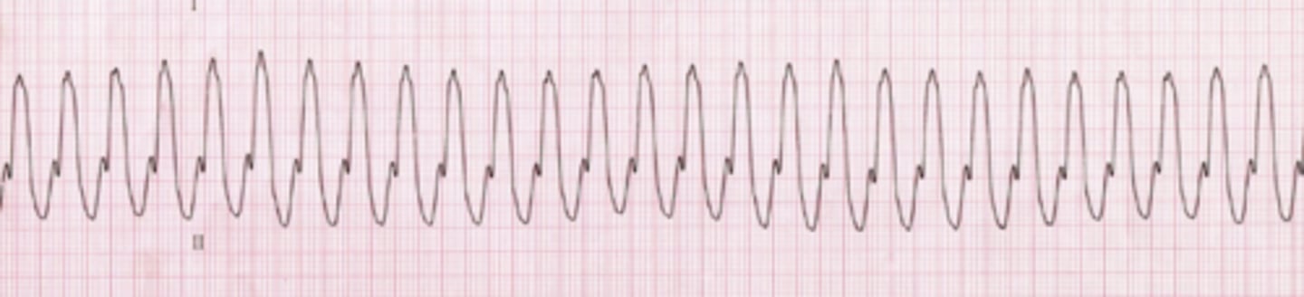 <p>Identify the tachyarrhythmia.</p>
