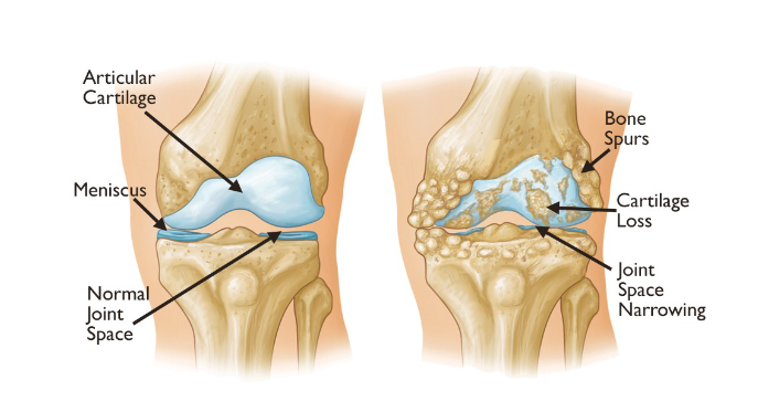 <p>Osteoarthritis</p>