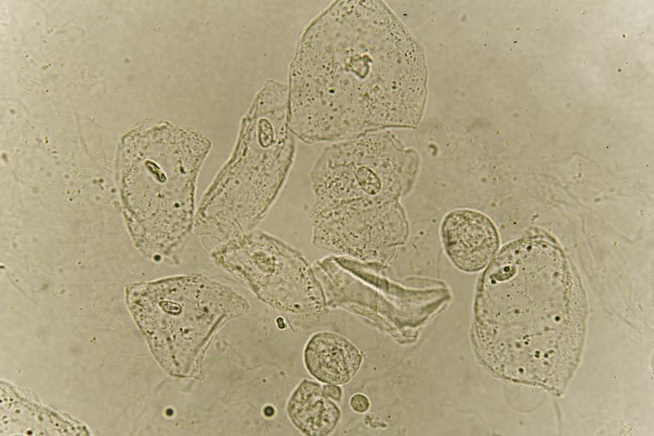 <p>What is in the urine sediment?</p>