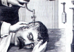 <p>The earliest example of brain surgery goes back around 6 thousand years ago in Cappadocia,Turkey. Surgical procedure creating an opening in the skull to relieve pressure or treat injuries.</p>