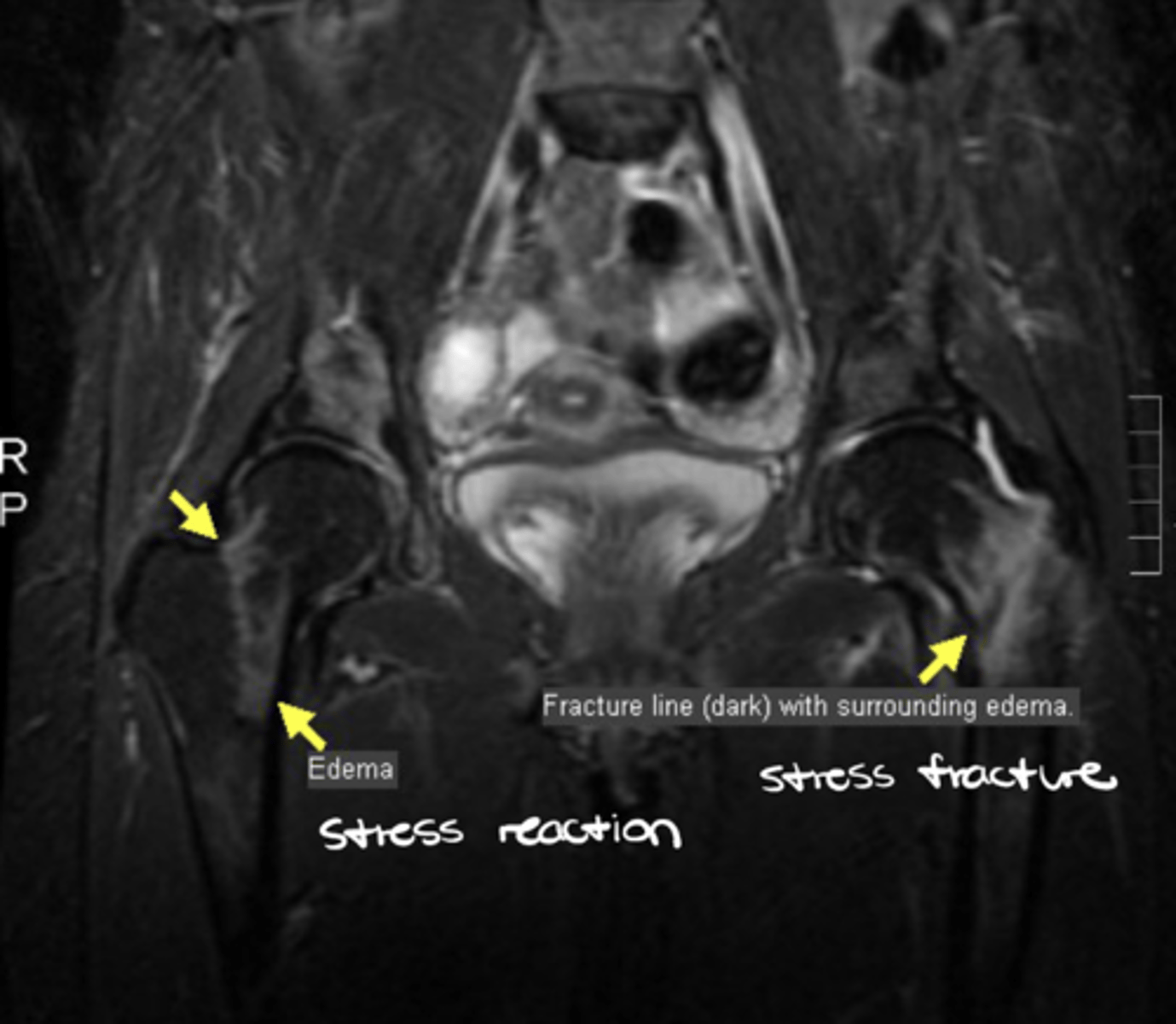 <p>Stress fracture</p>