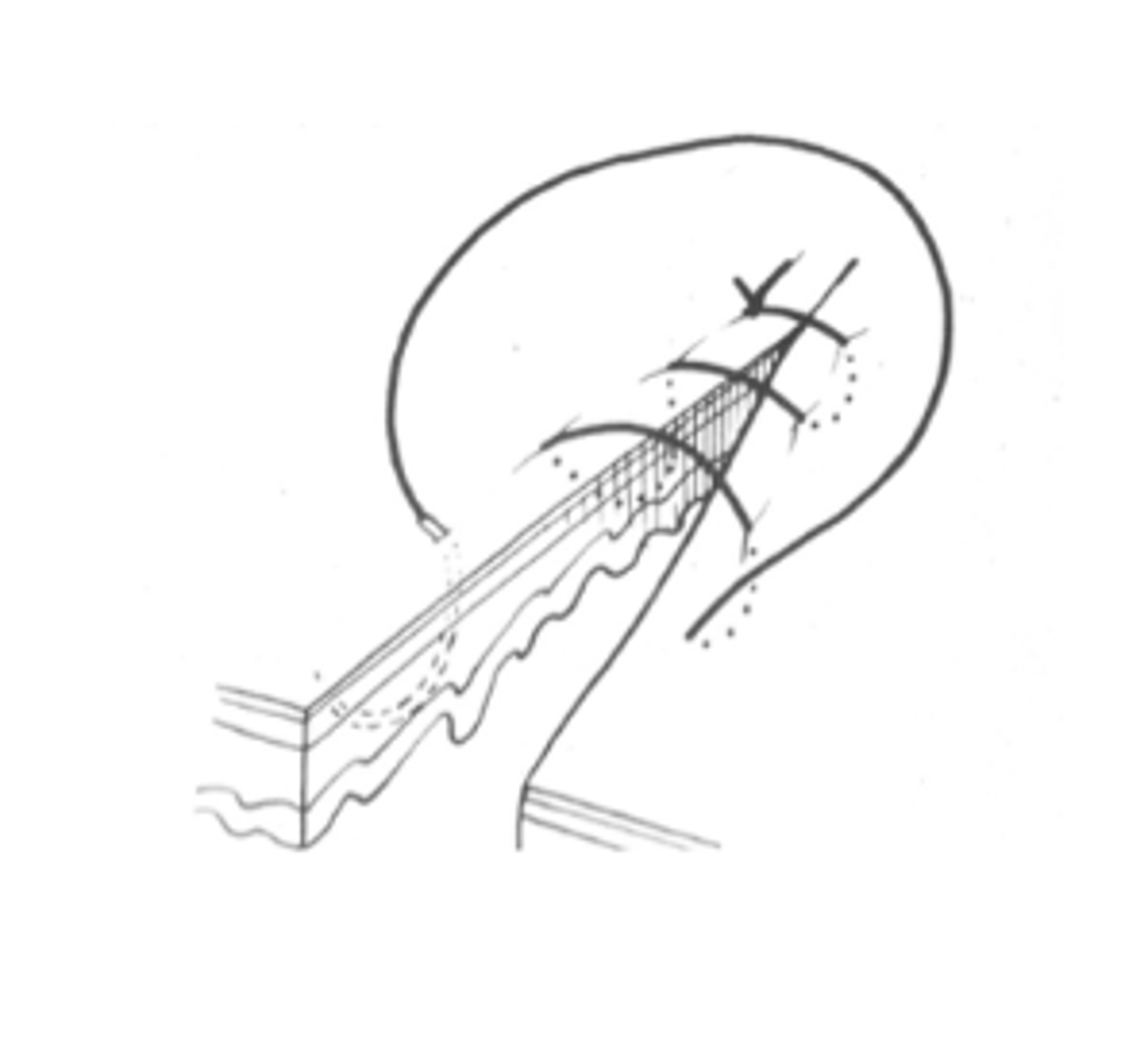 <p>- Bites on each side of the incision, parallel to the incision, pass into serosa, through muscularis and deep to submucosa, then passes back out without entering the lumen.</p>