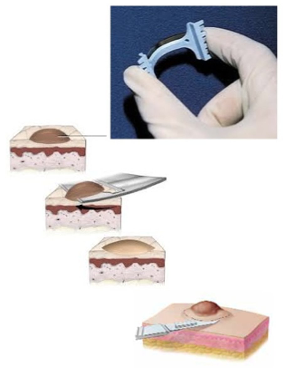 <p>Shave Biopsy</p>