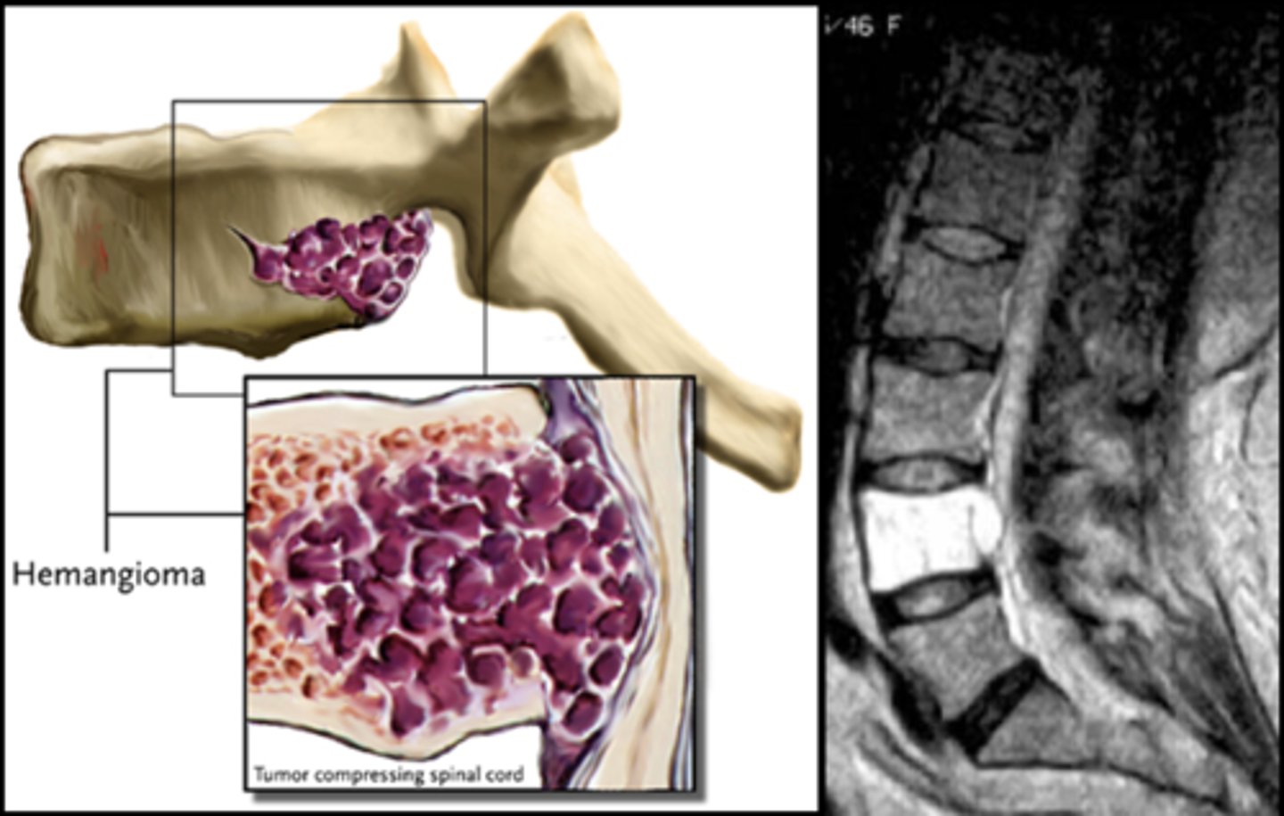 <p>_____ vertebral hemangioma</p>
