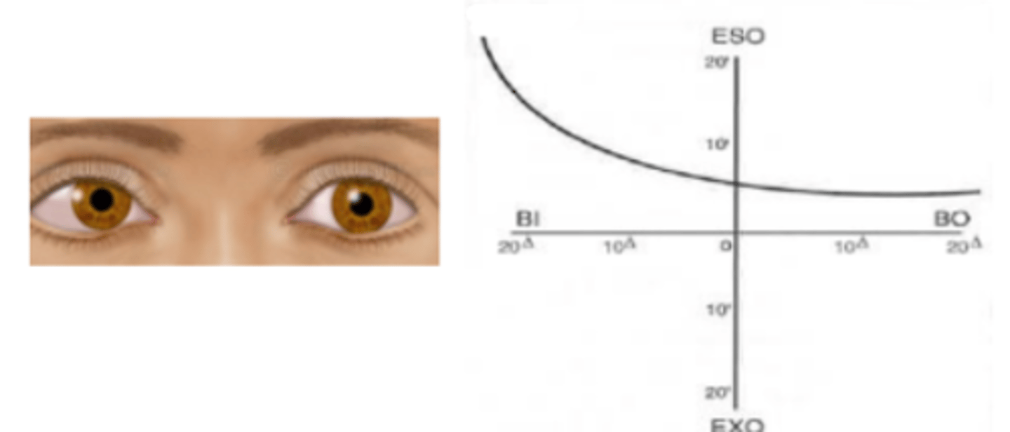<p>forced vergence fixation disparity curve that represents an intolerance of forced divergence (BI) as seen in patients having esophoria. Appears as a flat slope on the BO side and a steep slope on the BI side. Seen in about 25% of patients at distance and near.</p>