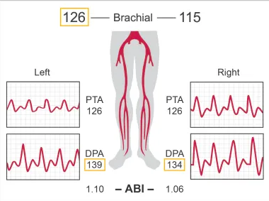 <p>Patient presents to ER via ambulance s/p MVA. ABI obtained in trauma bay by nurse. Is this ABI normal? </p>