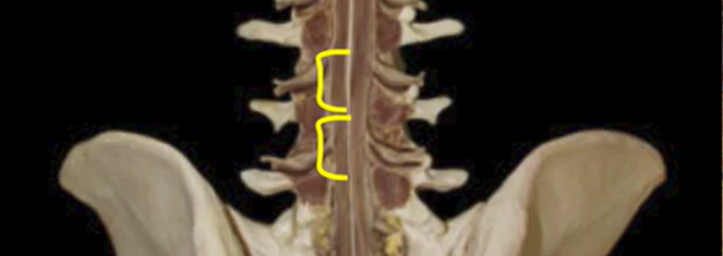 <p>A procedure to collect cerebrospinal fluid or relieve pressure, typically performed between L3-L4 or L4-L5.</p>