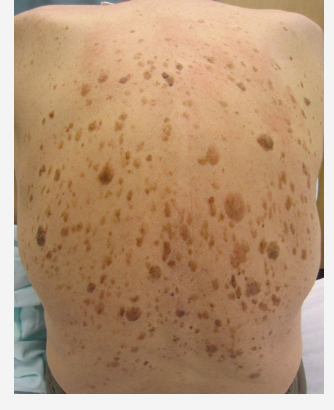 <ol><li><p><strong>Asymptomatic</strong>: lesions</p></li><li><p><span style="color: rgb(62, 52, 15);"><strong>Color: </strong></span>beige, brown, or black</p></li><li><p><span style="color: rgb(2, 2, 3);"><strong>Size:</strong></span> 0.3–2 cm</p></li><li><p><strong>Texture:</strong> <strong>velvety, greasy, or warty surface</strong></p></li><li><p><strong>Appearance:</strong> “<strong>Stuck-on</strong>” or pasted look on the skin</p></li></ol><p></p><p><span style="color: red;"><strong>Hx of very acute SKs= </strong></span><strong>Leser-Trélat sign—> </strong><span style="color: red;"><strong><u>can be a sign of GI cancer.  </u></strong></span></p><p></p>